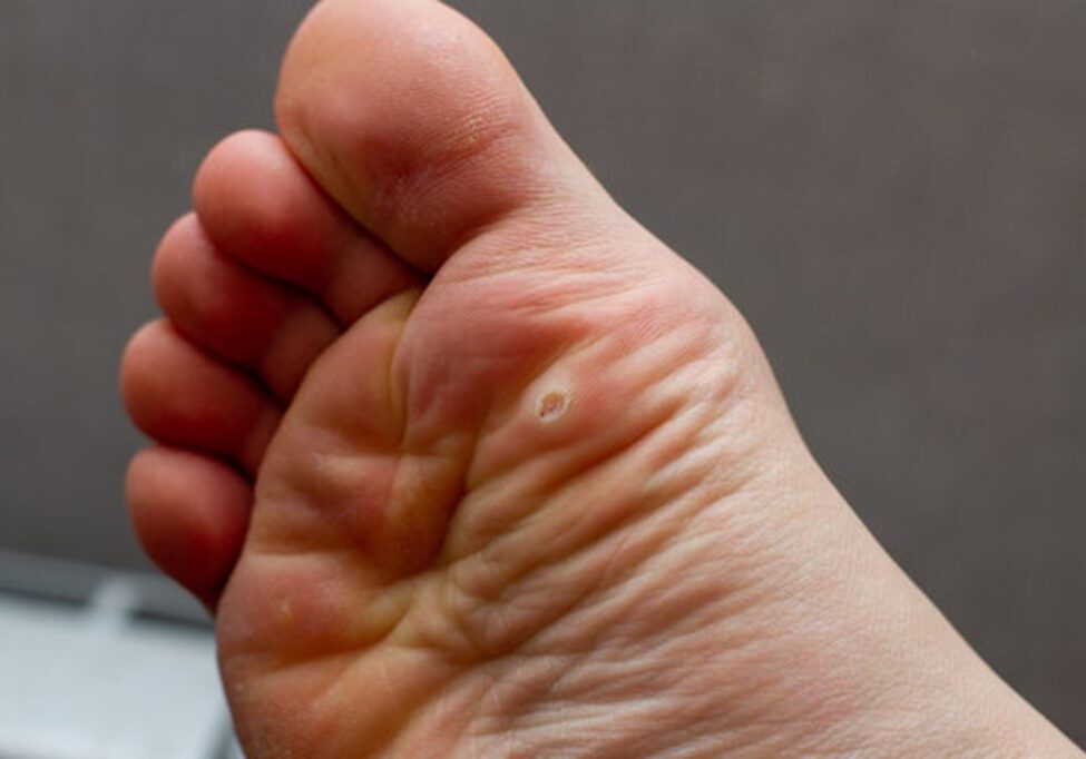 Close-up of a foot with a callus on the sole.